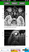 Normal Findings in CT and MRI Brain syot layar 3