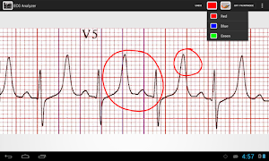 ECG Analyzer screenshot 1
