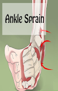 Ankle Sprain ภาพหน้าจอ 2