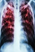tuberkulosis screenshot 1
