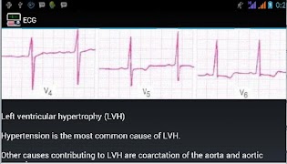 Ecg Interpretation captura de pantalla 4