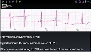 Ecg Interpretation captura de pantalla 4