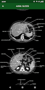 abdominal CT: annotated slices screenshot 2