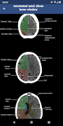 Brain CT : annotated slices imagem de tela 2