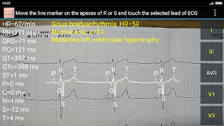 ECG Reader 2 free imagem de tela 3