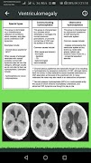 Brain CT Scan Interpretation imagem de tela 4