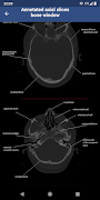Brain CT : annotated slices screenshot 3