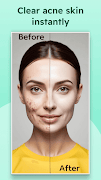 Remove Acne from Face Screenshot 5