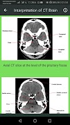 Brain CT Scan Interpretation Screenshot 5