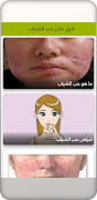 طرق علاج حب الشباب - بدون نت - পোস্টার