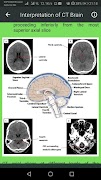 Brain CT Scan Interpretation ảnh chụp màn hình 6