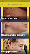 Hyperpigmentation: Skin Spots 스크린샷 4