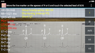 ECG Reader 2 free ภาพหน้าจอ 5