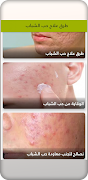 طرق علاج حب الشباب - بدون نت - imagem de tela 3