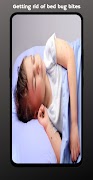 Bed bugs bites ảnh chụp màn hình 1