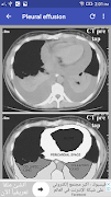 CT Chest Interpretation ภาพหน้าจอ 5