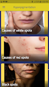 Hyperpigmentation: Skin Spots スクリーンショット 3