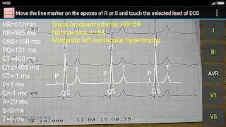 ECG Reader 2 free screenshot 4