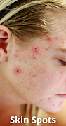 Hyperpigmentation: Skin Spots captura de pantalla 6