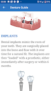 Dentures guide: Types, Crowns, ภาพหน้าจอ 4