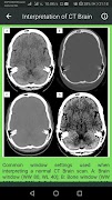 Brain CT Scan Interpretation imagem de tela 1