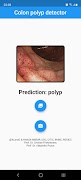 Polyp detector screenshot 3