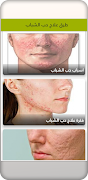 طرق علاج حب الشباب - بدون نت - ảnh chụp màn hình 1