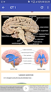 CT Head Basic Interpretation screenshot 1