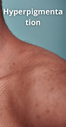 Hyperpigmentation: Skin Spots Screenshot 2