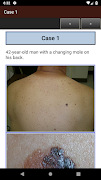 Dermoscopy Two Step Algorithm ảnh chụp màn hình 6