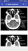 CT Brain Interpretation 스크린샷 1