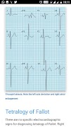 ECG Basics - Full ảnh chụp màn hình 4