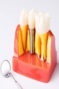 Dental Implants poster