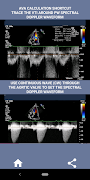 AORTIC STENOSIS PROTOCOL GUIDE captura de pantalla 7