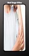 Bed bugs bites syot layar 2