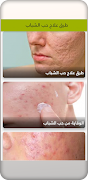 طرق علاج حب الشباب - بدون نت - Screenshot 2