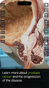 برنامه‌نما INSIGHT PROSTATE عکس از صفحه