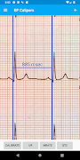 EP Calipers Screenshot 1