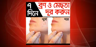 ৭ দিনে ব্রণ ও মেছতা দূর করুন - Bron mesta dur