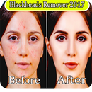 APK Blackheads Remover