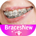 BracesNew