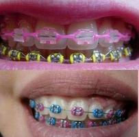 Braces Teeth imagem de tela 2