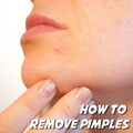 How to Remove Pimples