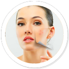 How to Get Rid of Acne Zeichen