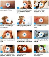 How to Get Rid of Acne ภาพหน้าจอ 1