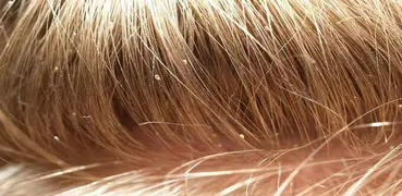 Head Lice Tips