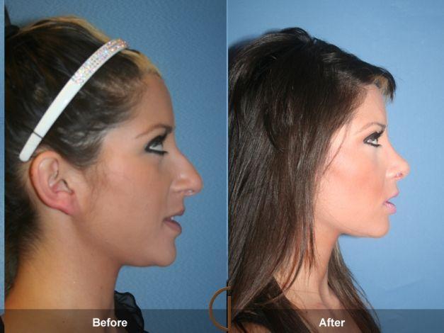 55 HQ Photos Nose Job App Android / Leah Mcsweeney Got Nose Job Before After Photos Style Living
