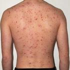 آیکون‌ Home Remedy for Chicken Pox