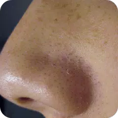 Remove Blackheads Home Remedy APK Herunterladen