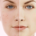 ”How to Get Rid of Pimples